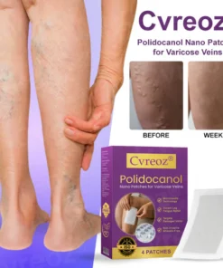 Cvreoz® Polidocanol Nano Patches for Varicose Veins