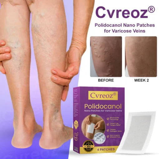 Cvreoz® Polidocanol Nano Patches for Varicose Veins