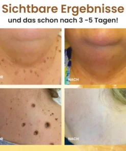 Dobshow® Bee Venom Warts & Moles Removal