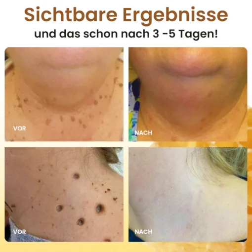 Dobshow® Bee Venom Warts & Moles Removal