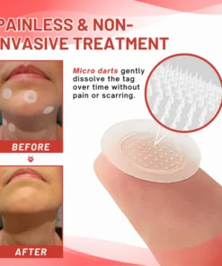 Fivfivgo® MicroDart Skin Tag Remover Patch