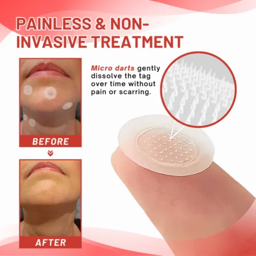 Fivfivgo® MicroDart Skin Tag Remover Patch