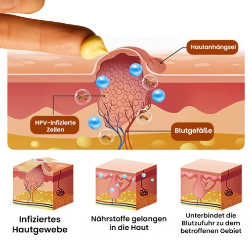 Dobshow® Bee Venom Warts & Moles Removal