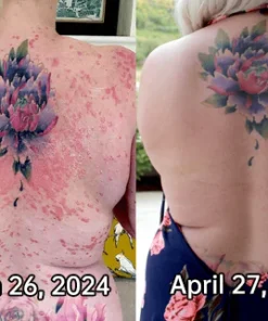 LOVILDS™ PsoriaHeal Psoriasis Spray