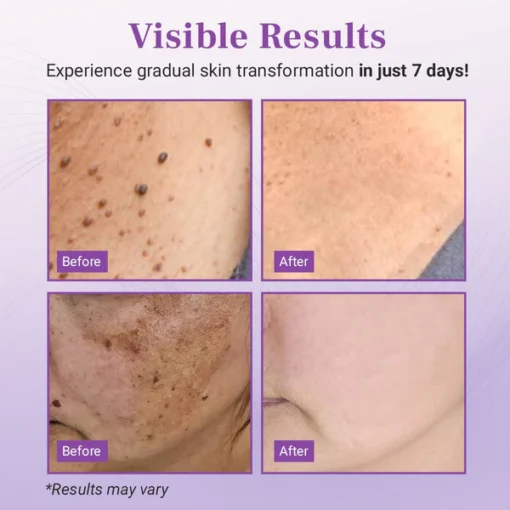 Fivfivgo® DermaClear Mole and Dark Spot Removal Bio-Gel