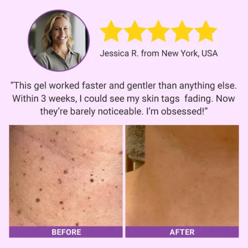 Fivfivgo® DermaClear Mole and Dark Spot Removal Bio-Gel