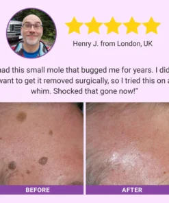 Fivfivgo® DermaClear Mole and Dark Spot Removal Bio-Gel
