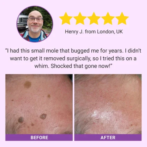Fivfivgo® DermaClear Mole and Dark Spot Removal Bio-Gel