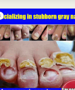 Fungal Nail Treatment Cream