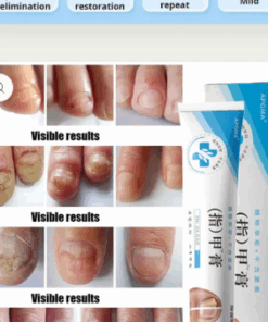 Fungal Nail Treatment Cream